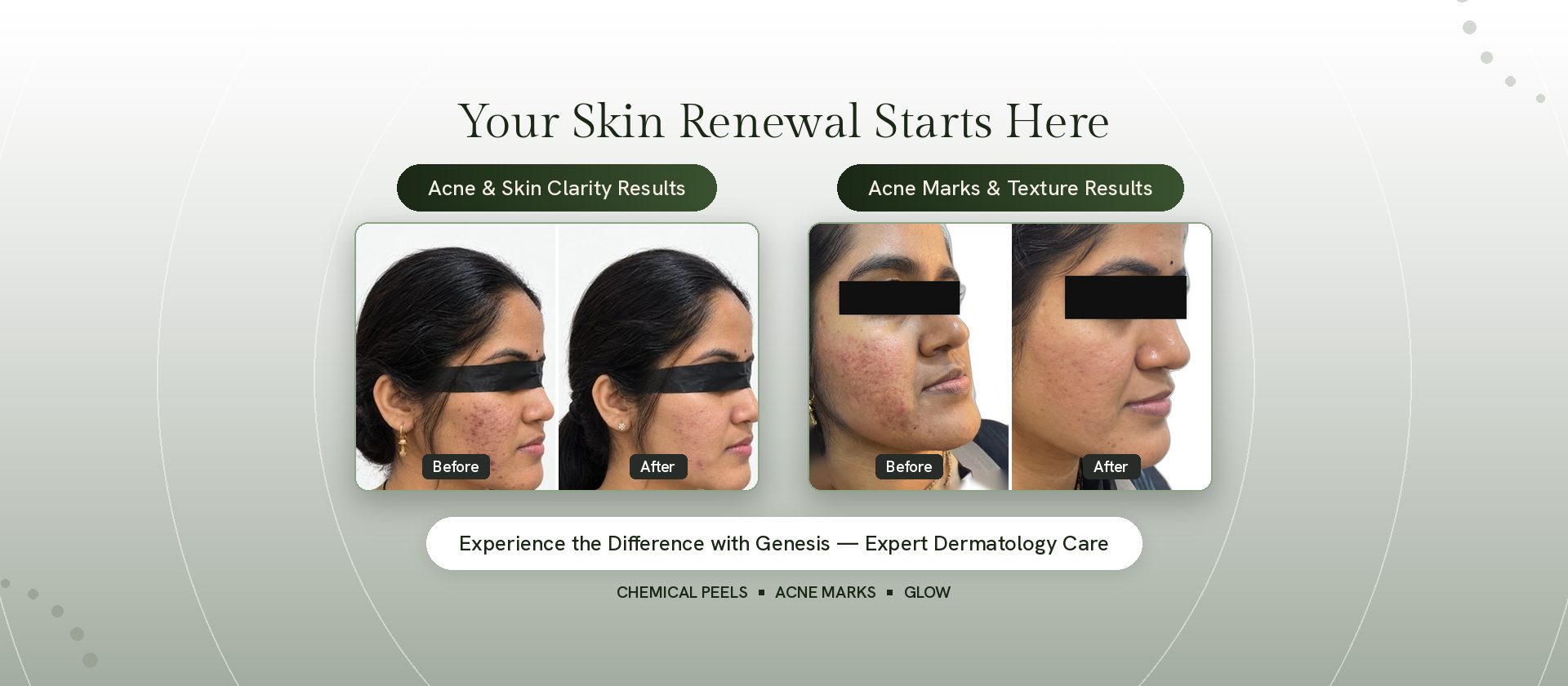 Chemical peel before and after results at Genesis Dermatology, Chennai