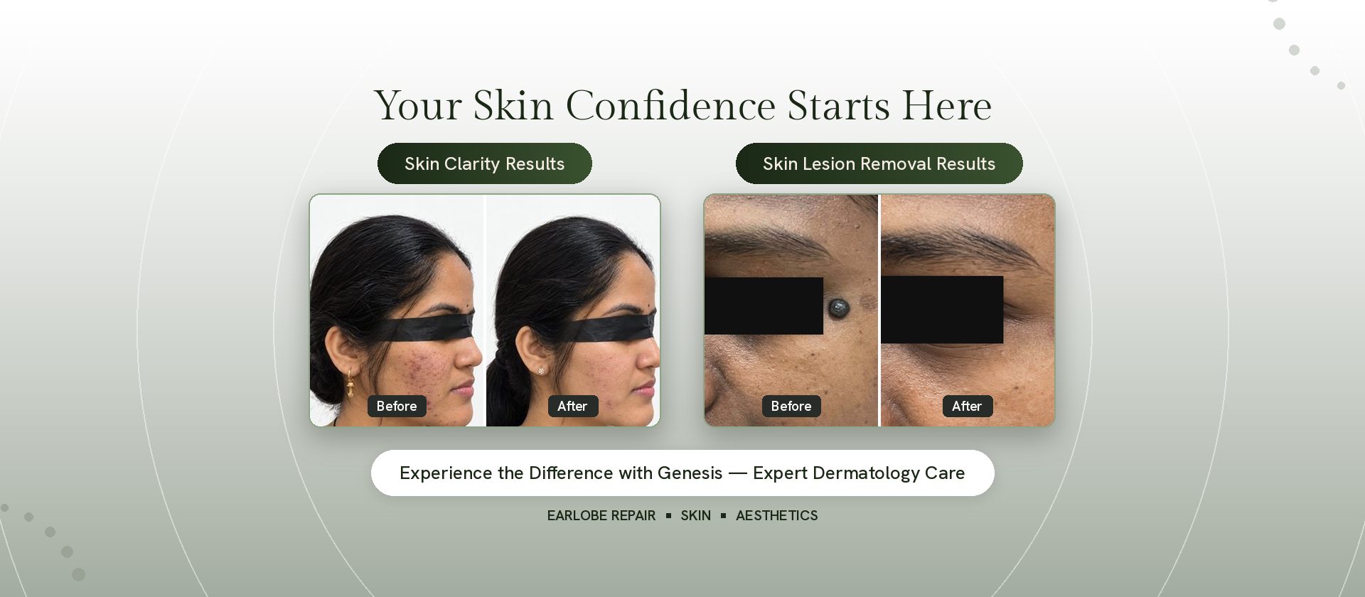Skin before and after results at Genesis Dermatology, Chennai