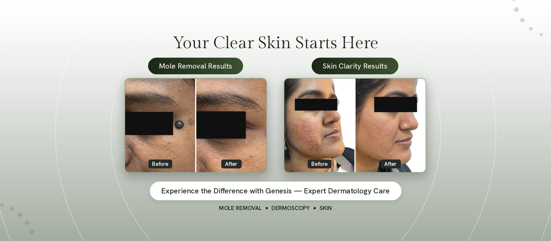 Mole removal before and after results at Genesis Dermatology, Chennai