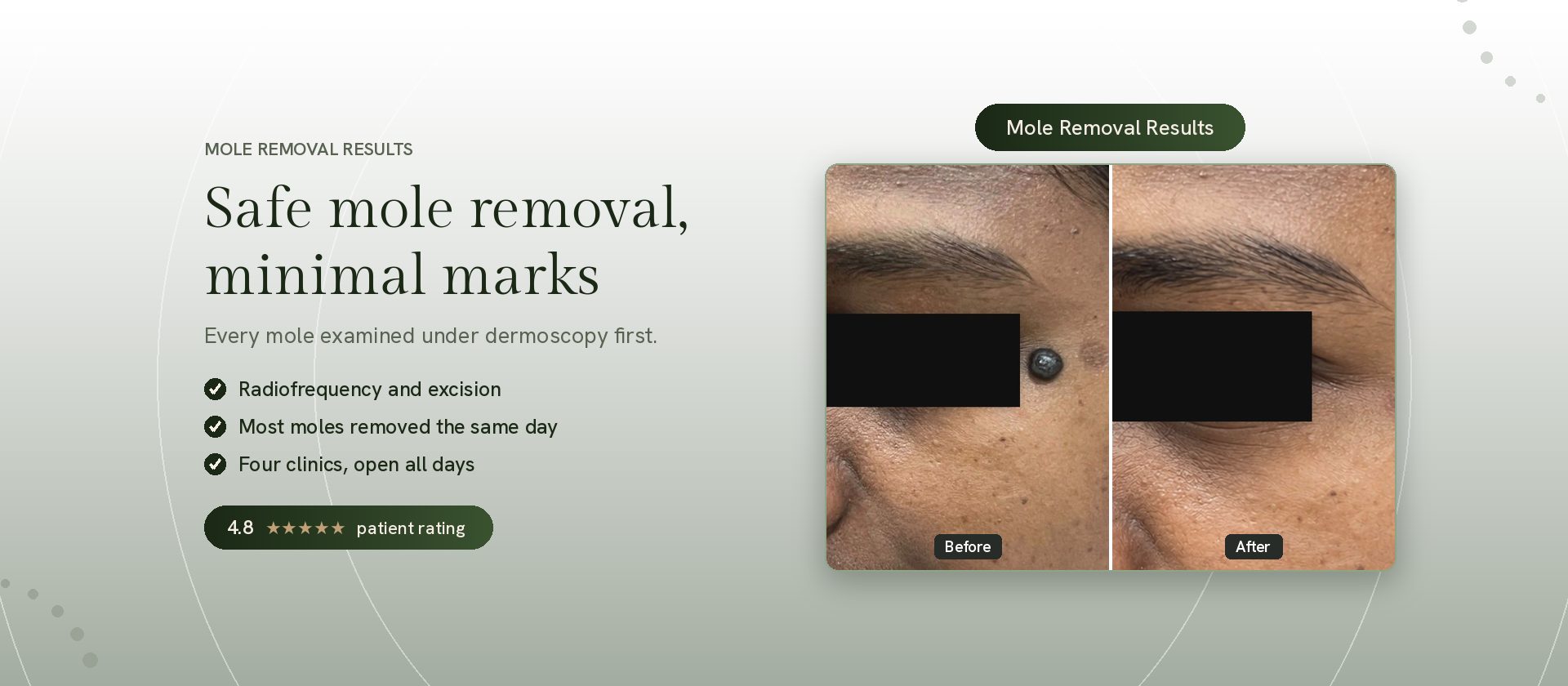 Mole removal treatment results by a qualified dermatologist at Genesis Dermatology