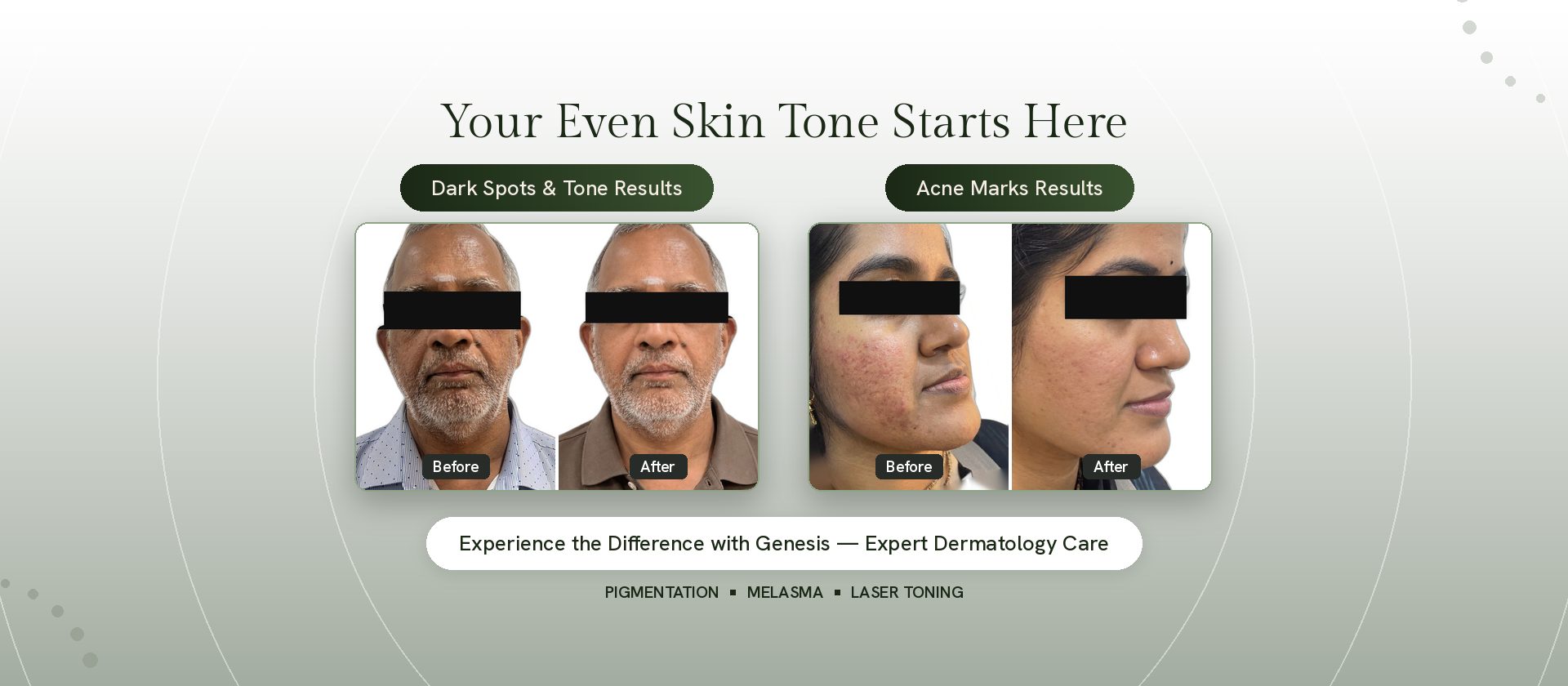 Pigmentation before and after results at Genesis Dermatology, Chennai