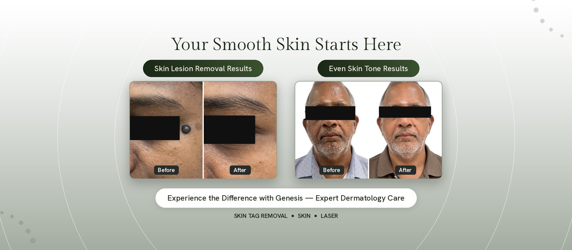 Skin before and after results at Genesis Dermatology, Chennai