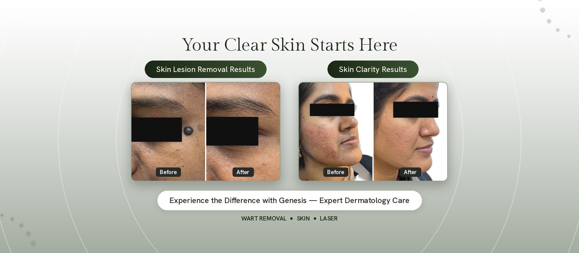 Skin before and after results at Genesis Dermatology, Chennai