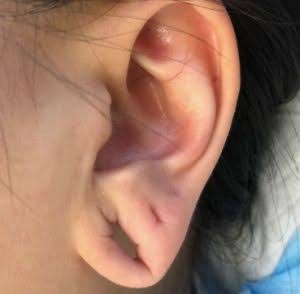 Earlobe repair doctor in Chennai carrying out the repair under local anaesthesia
