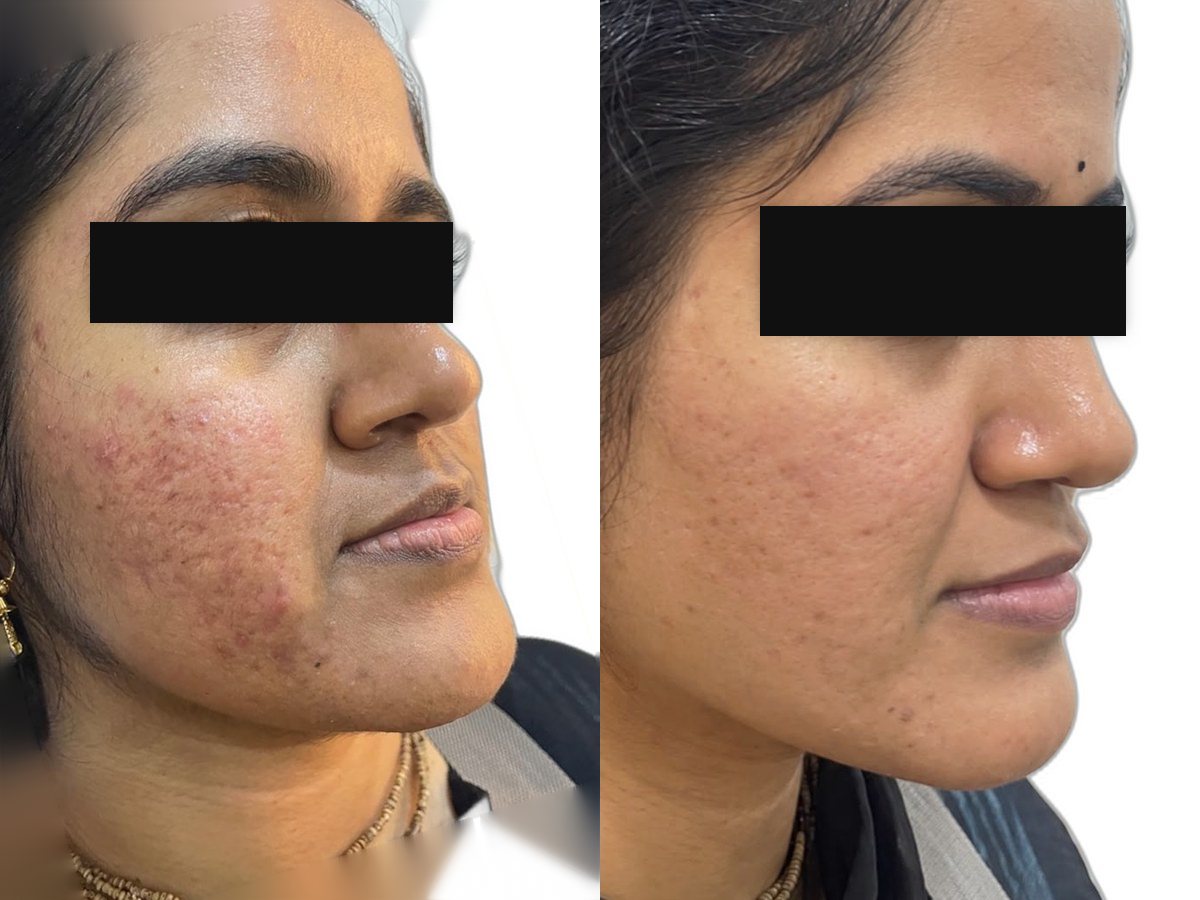 Acne and acne marks, before treatment