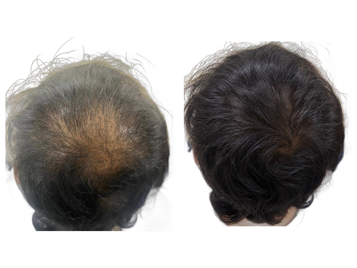 Thinning at the crown, before treatment