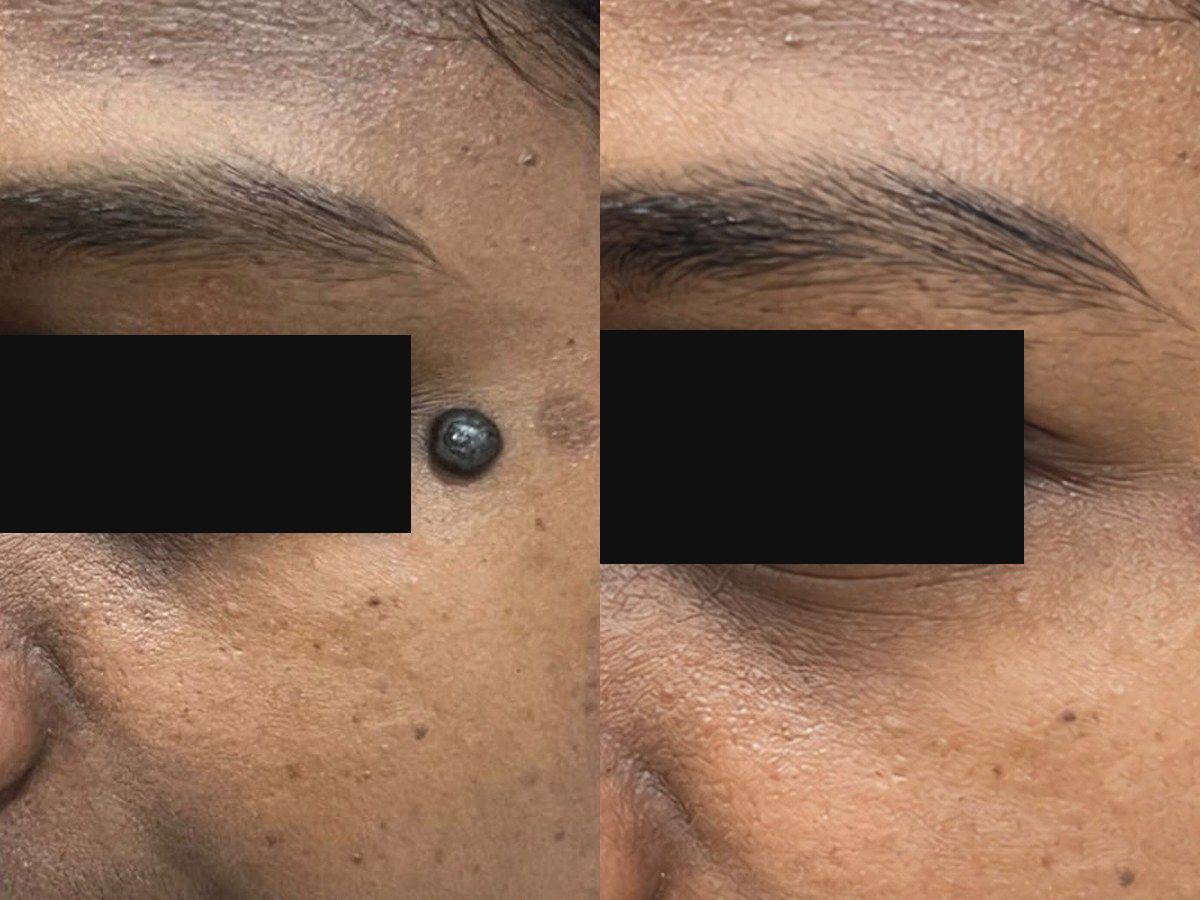 Mole removal near the eye, before treatment
