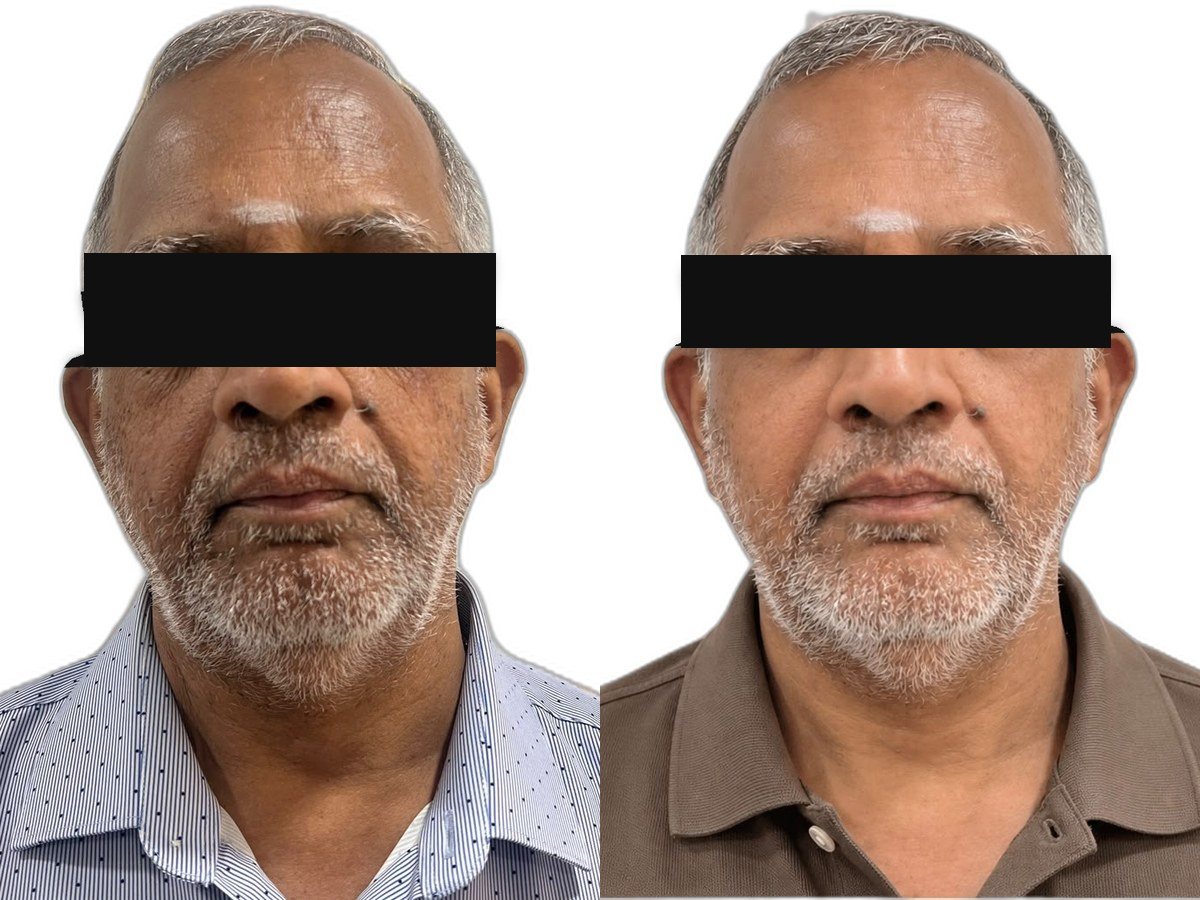 Dark spots and uneven skin tone, before treatment