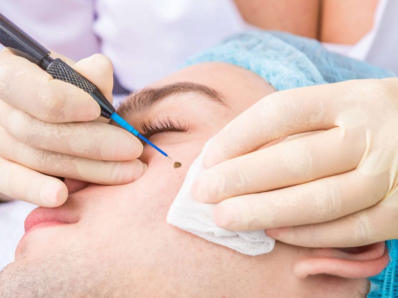 Mole removal at Genesis Dermatology, Chennai
