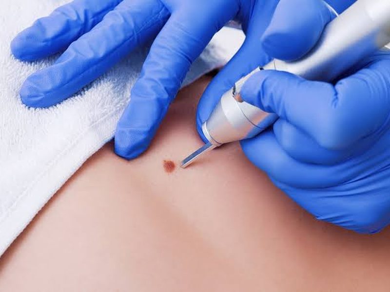Skin tag removal at Genesis Dermatology, Chennai