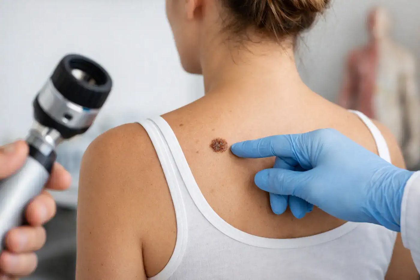 Mole removal doctor in Chennai examining a mole under magnification before removal