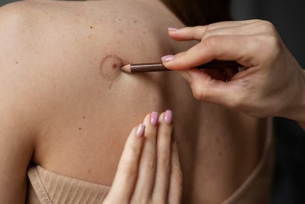 Inside our skin tag removal clinic in Chennai, where a dermatologist consults seven days a week