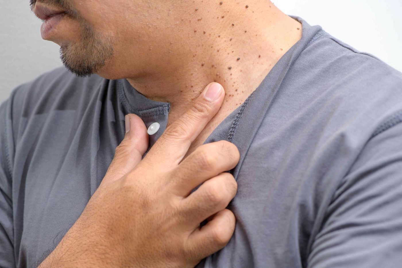 Skin tag removal dermatologist in Chennai treating tags under local anaesthesia