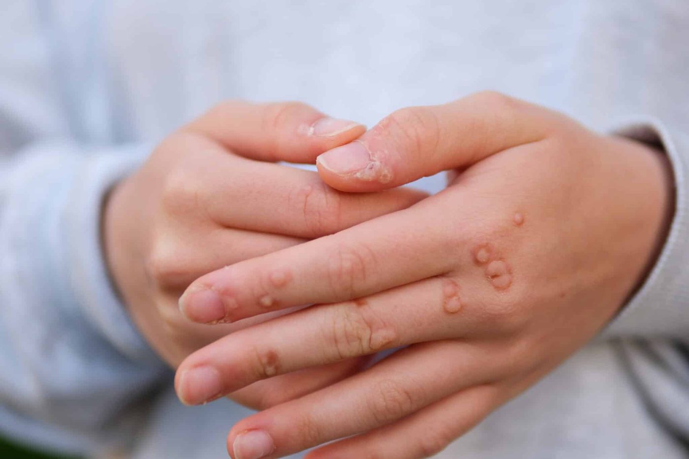 Wart removal doctor in Chennai treating a wart with cautery at the clinic