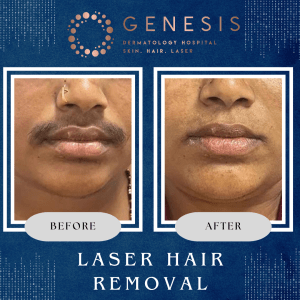 Woman receiving professional laser hair removal treatment at Genesis Dermatology, Chennai. Clinic staff using advanced laser equipment in a clean, modern dermatology center.