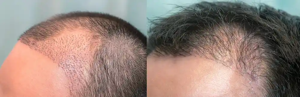 hair transplant aftercare
